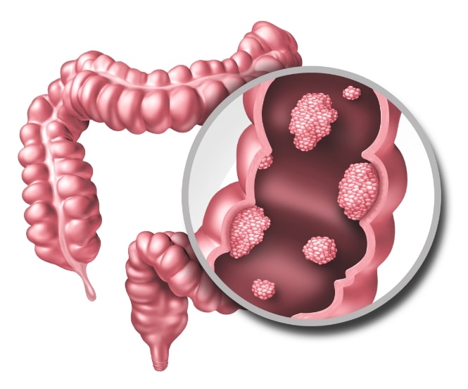 Diagram of the large intestine, with a magnified view of malignant polyps