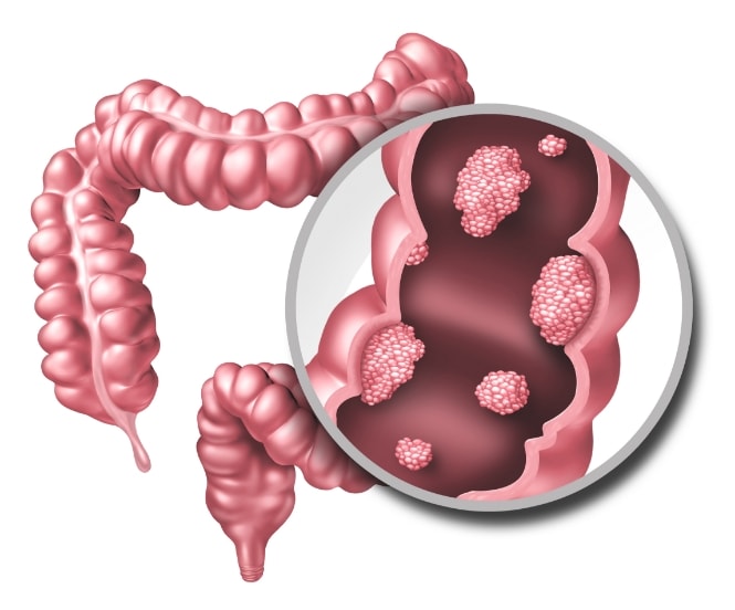 Diagram of the large intestine, with a magnified view of malignant polyps